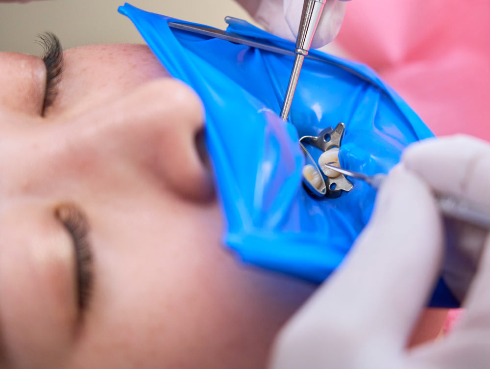 ラバーダム防湿