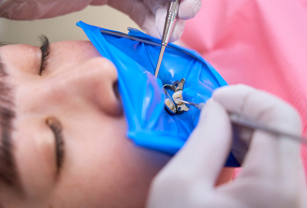 ラバーダムのイメージ